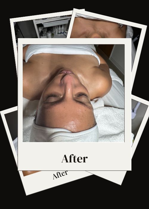 Facial Before and After